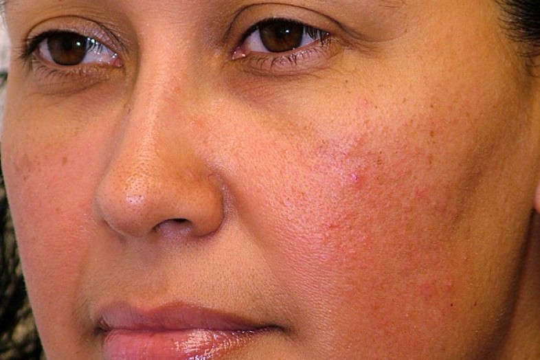 Clear facial redness